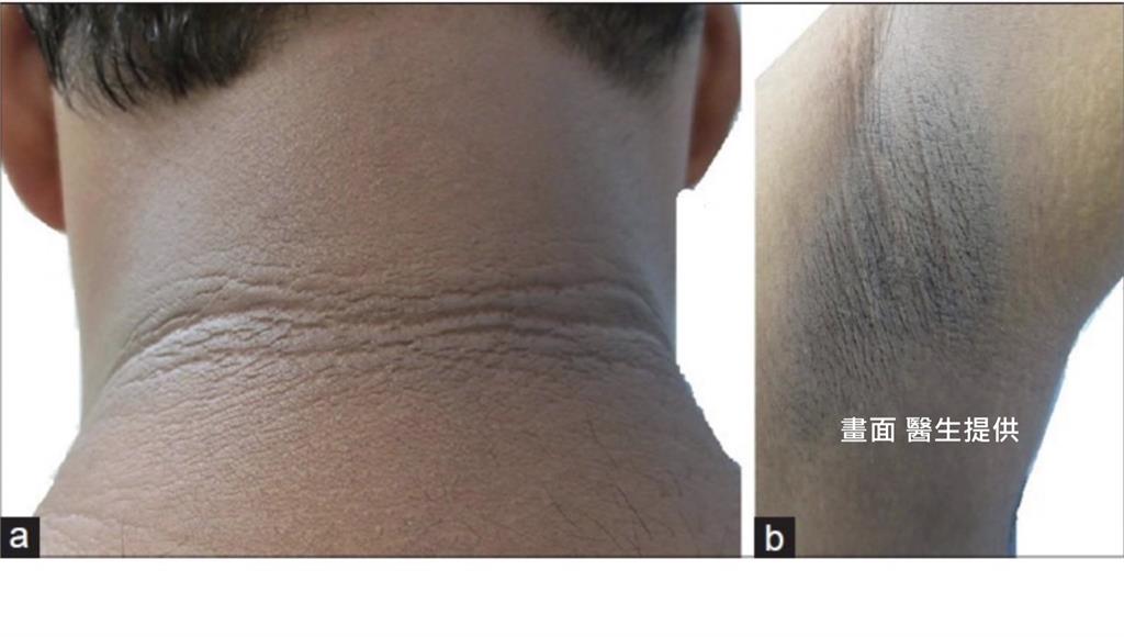 黑色棘皮症可能是癌症的徵兆。圖／醫師提供