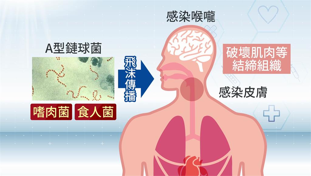 肌肉像被吃掉一塊！ 日本爆「食人菌」疫情。圖／台視新聞